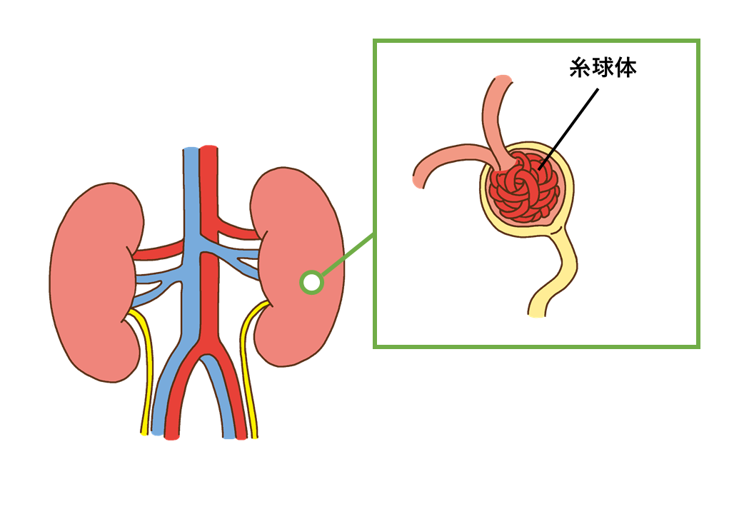 急性糸球体腎炎01