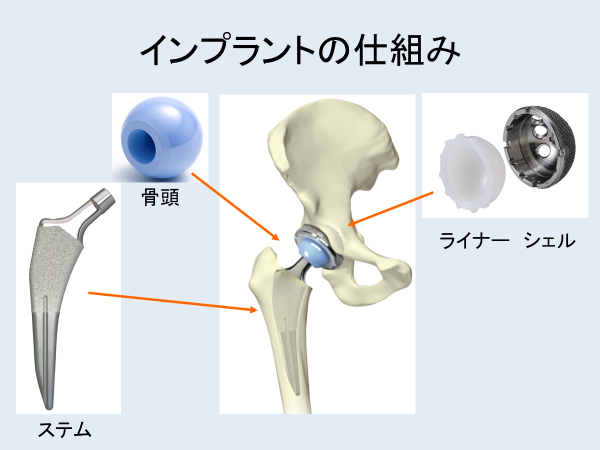 人工関節設置のイメージ画像