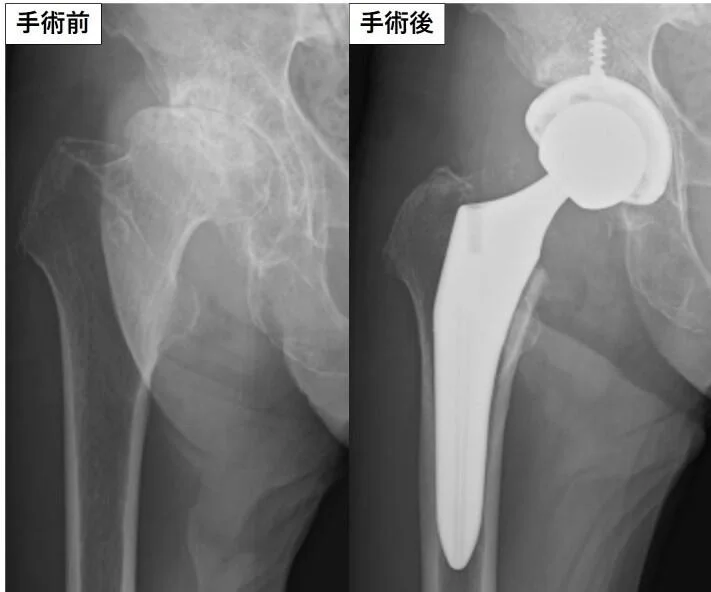 人工股関節全置換術の術前後画像