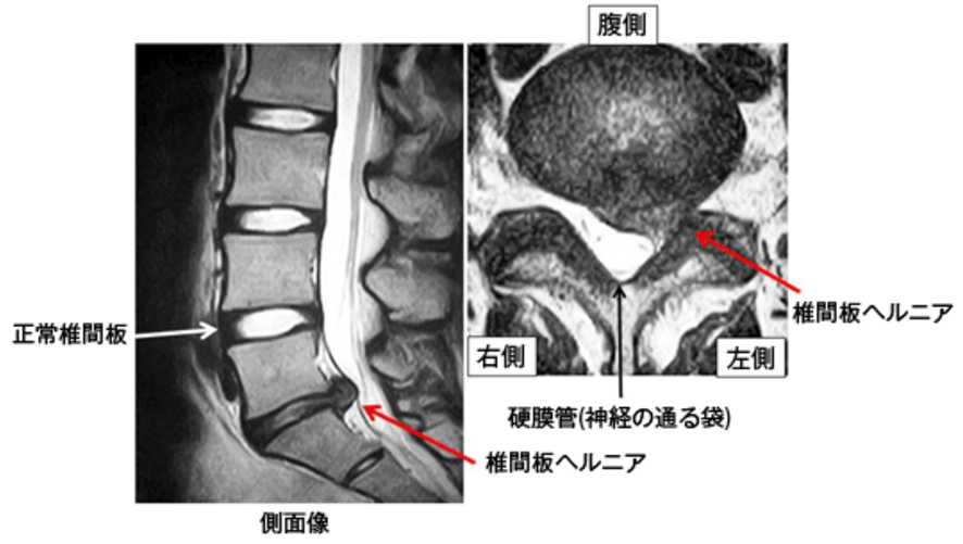 MRI検査：椎間板が後方に突出し、神経を圧迫している