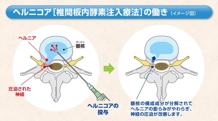 ヘルニコア（椎間板内酵素注入療法）の働き
