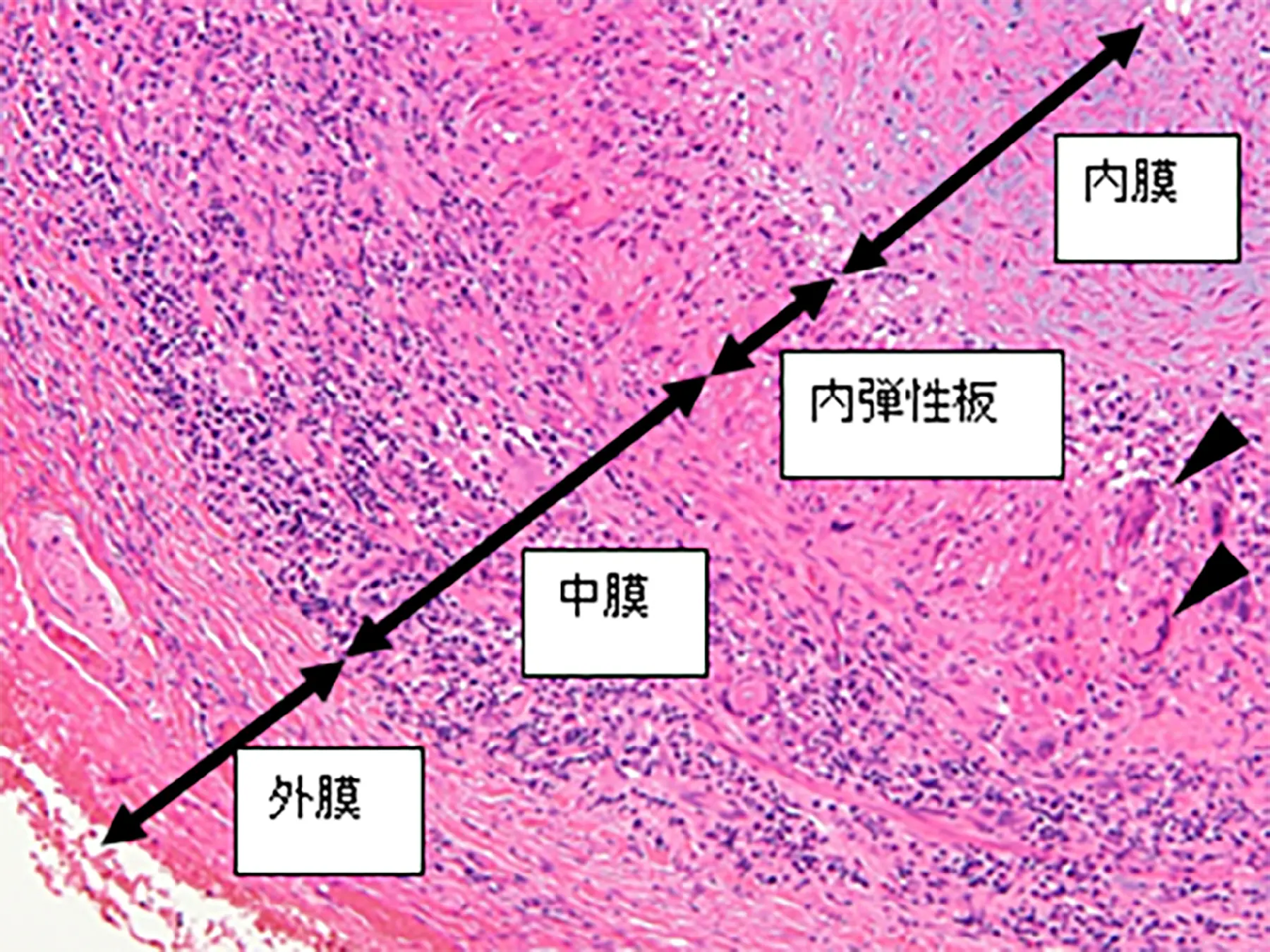 巨細胞性動脈炎の側頭動脈の病理所見