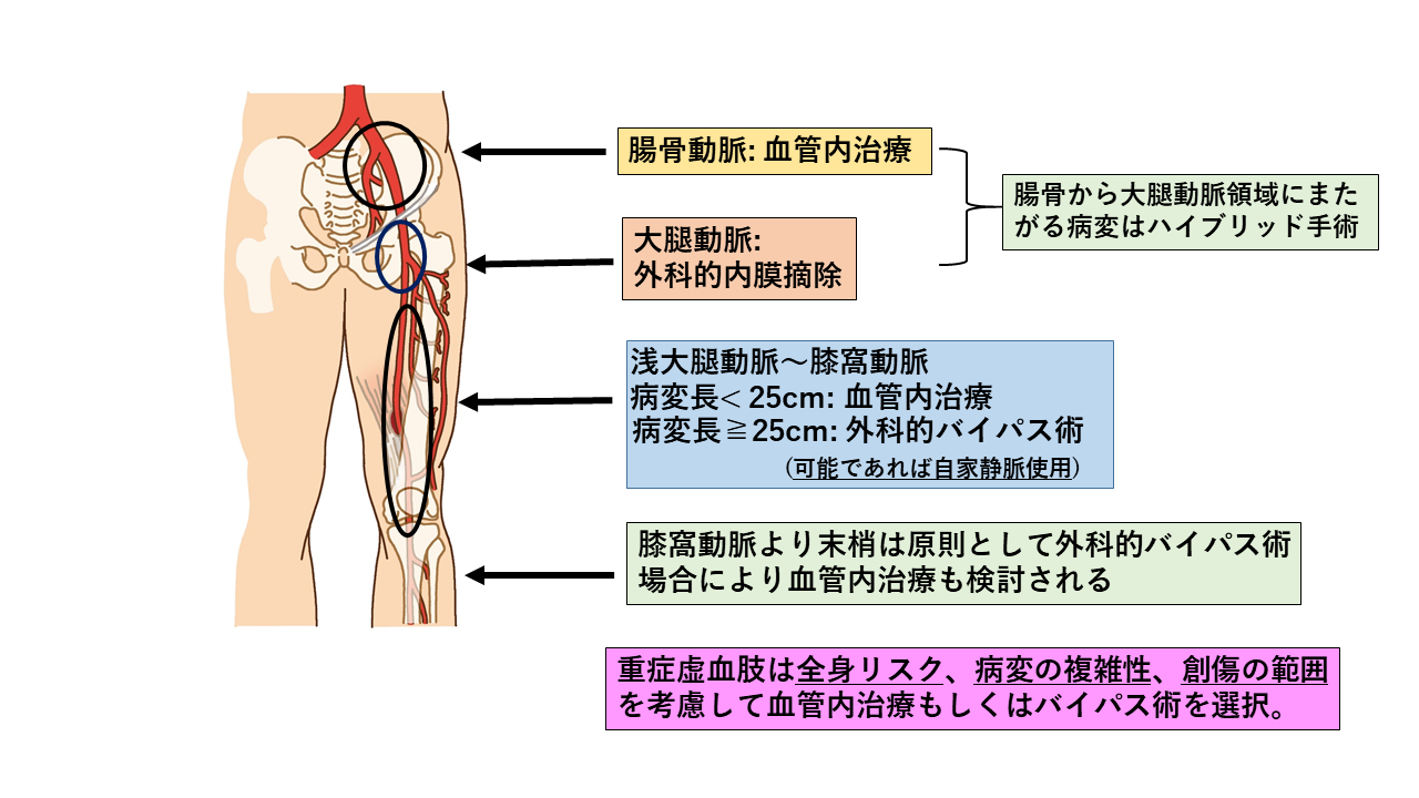 末梢動脈疾患ガイドラインに基づく治療アルゴリズム
