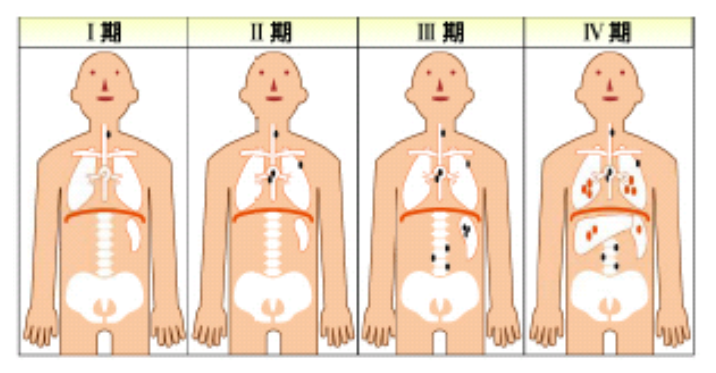 悪性リンパ腫の進行度　病期分類