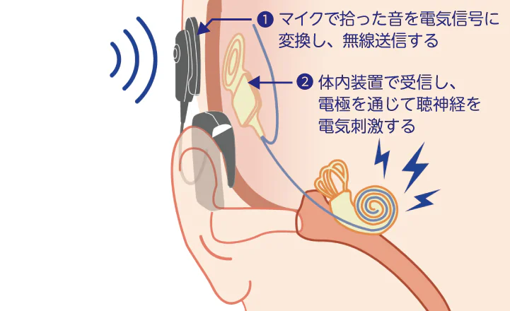 人工内耳の仕組み 画像 (2)