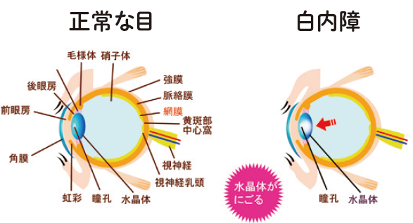 白内障の治療04