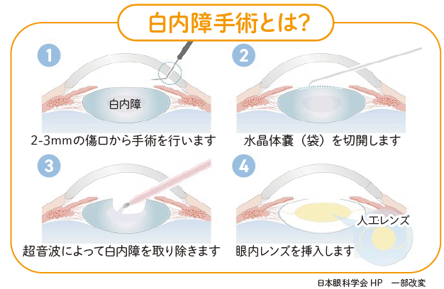 白内障の治療05