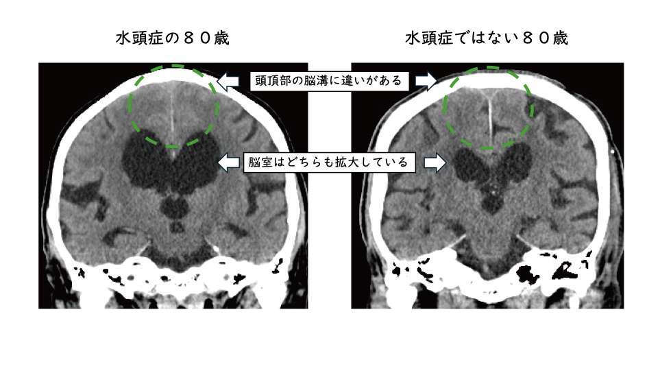 水頭症02