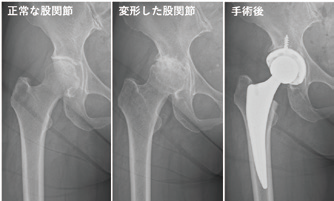 人工股関節01