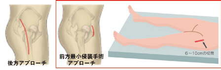人工股関節02