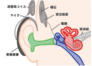 人工内耳手術01