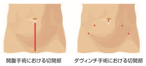内視鏡的前立腺摘除術01