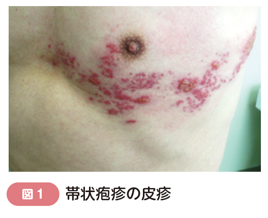 帯状疱疹ワクチン01