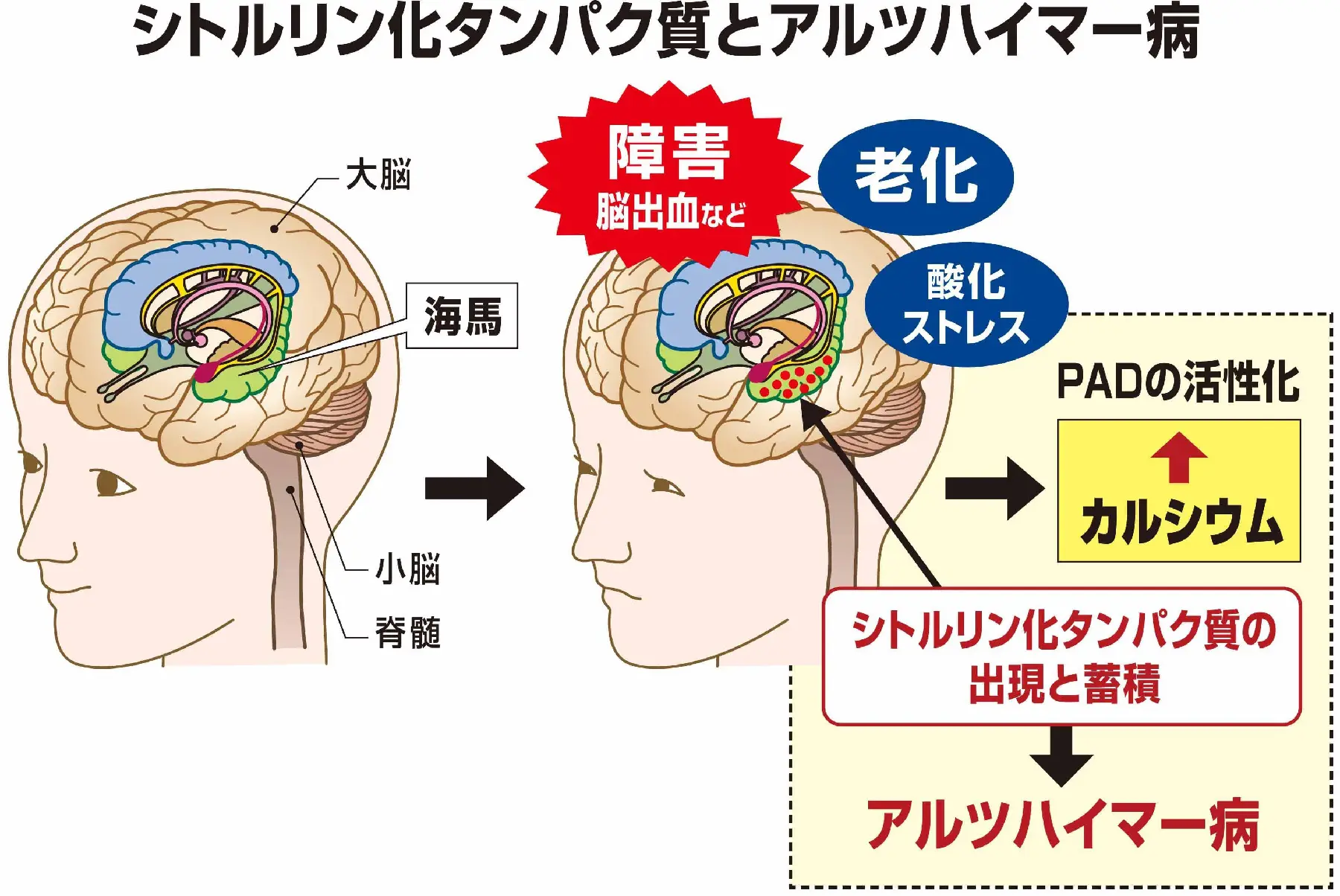 シトルリン化タンパク質とアルツハイマー病