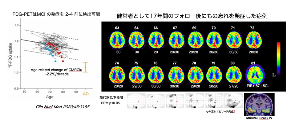 軽度認知障害（MCI）発症前の[18F]FDG-PET画像