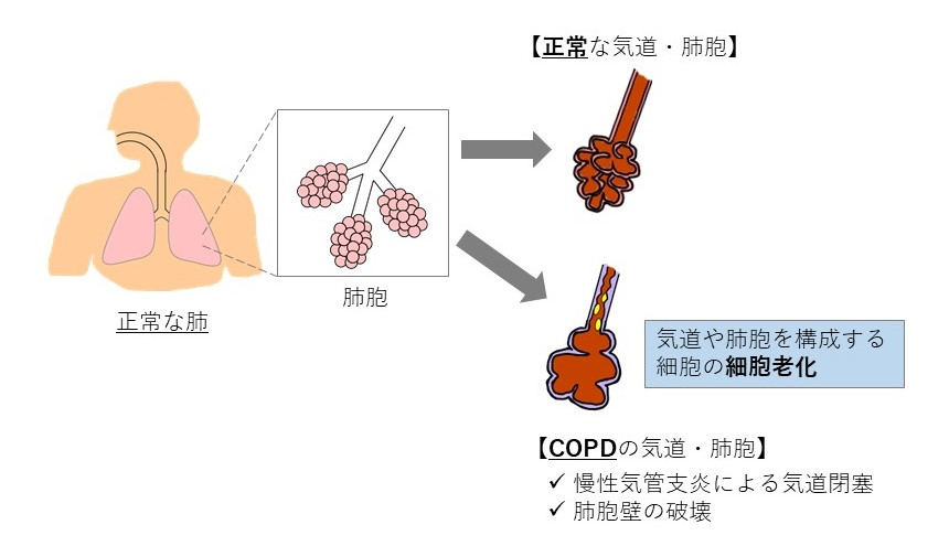 老化細胞とCOPD（慢性閉塞性肺疾患）02